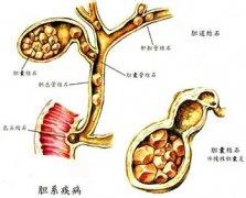 胆囊结石的临床症状表现？.jpg